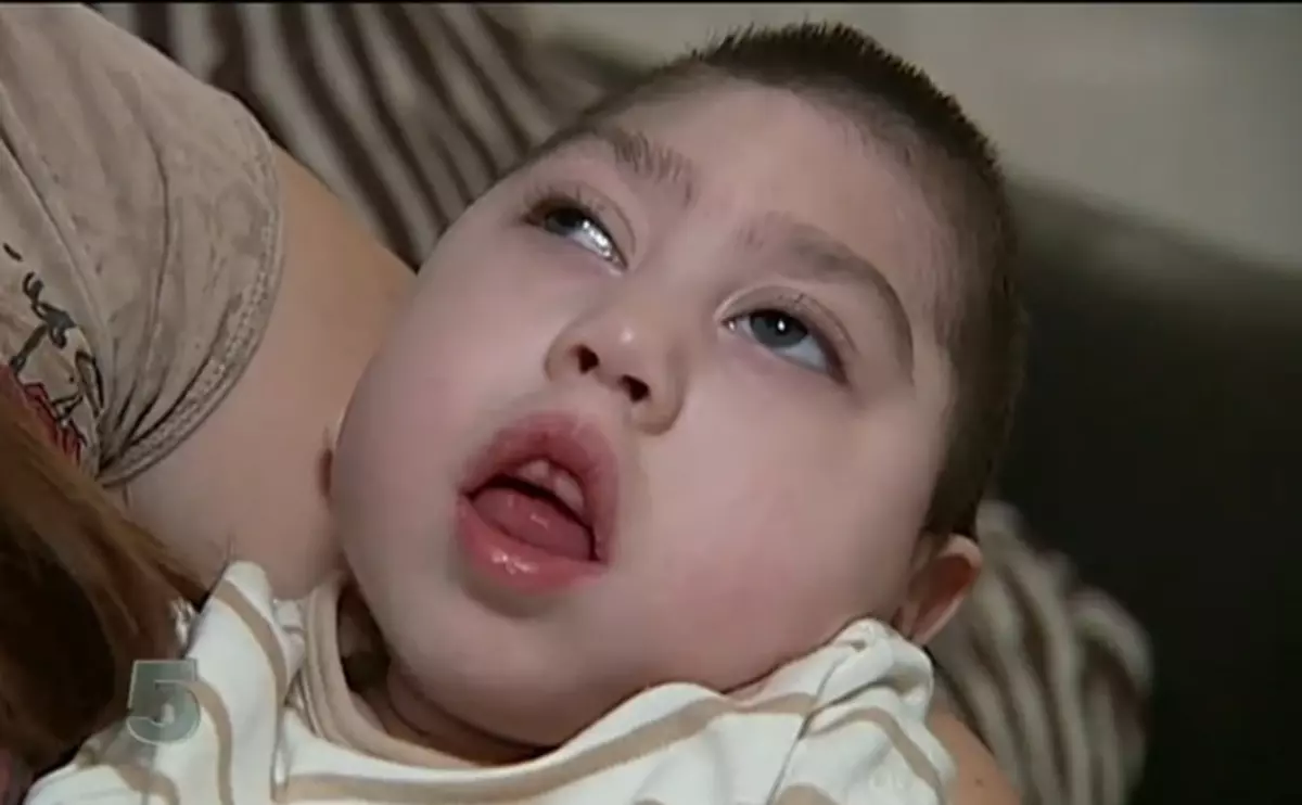 Copilul fără creier, caz uluitor pentru medici. Drama din fiecare secundă a vieţii unei mame
