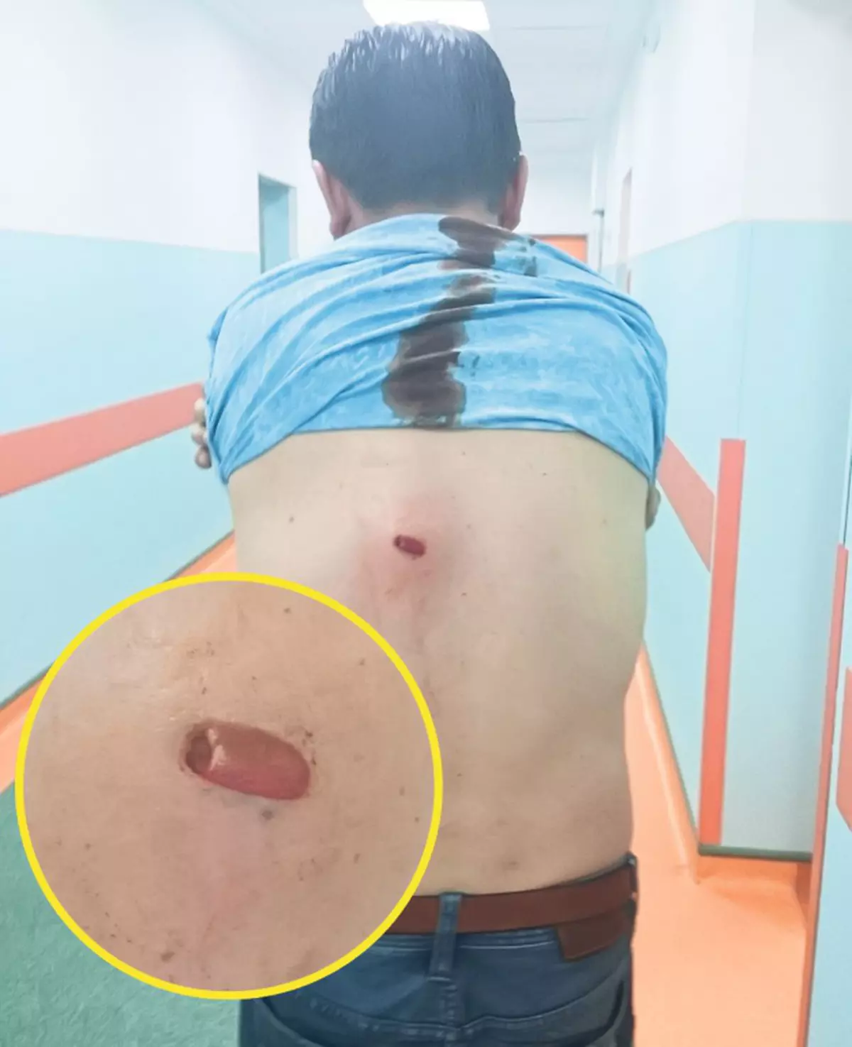 Un glonţ buclucaş i-a găurit spatele de la 2 kilometri
