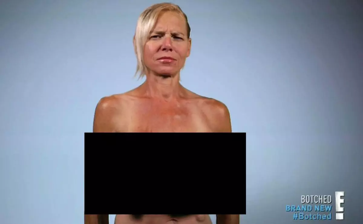 Femeia cu silicoane de 13 kilograme, la un pas de moarte după spargerea unui implant! IMAGINI ŞOCANTE