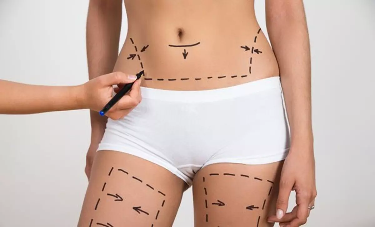 2.000 de euro – un lifting corporal total. Merită?
