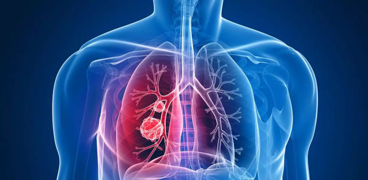 Simptomele cancerului pulmonar