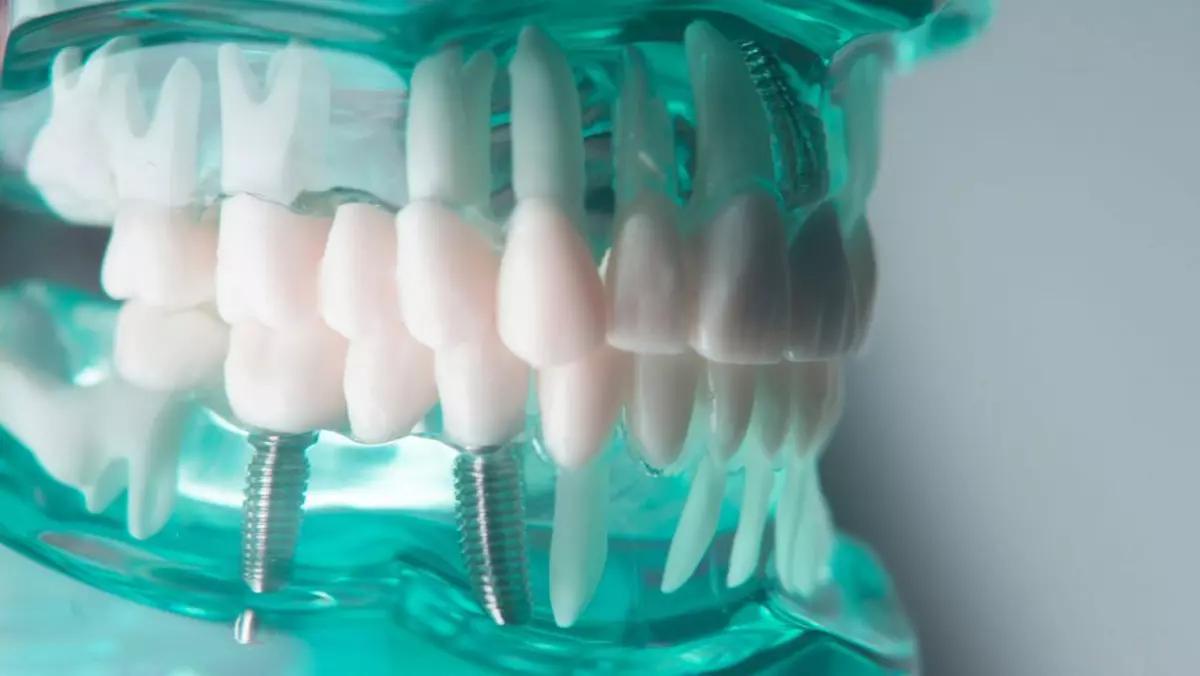 Implant Studio - Zâmbete perfecte fără durere