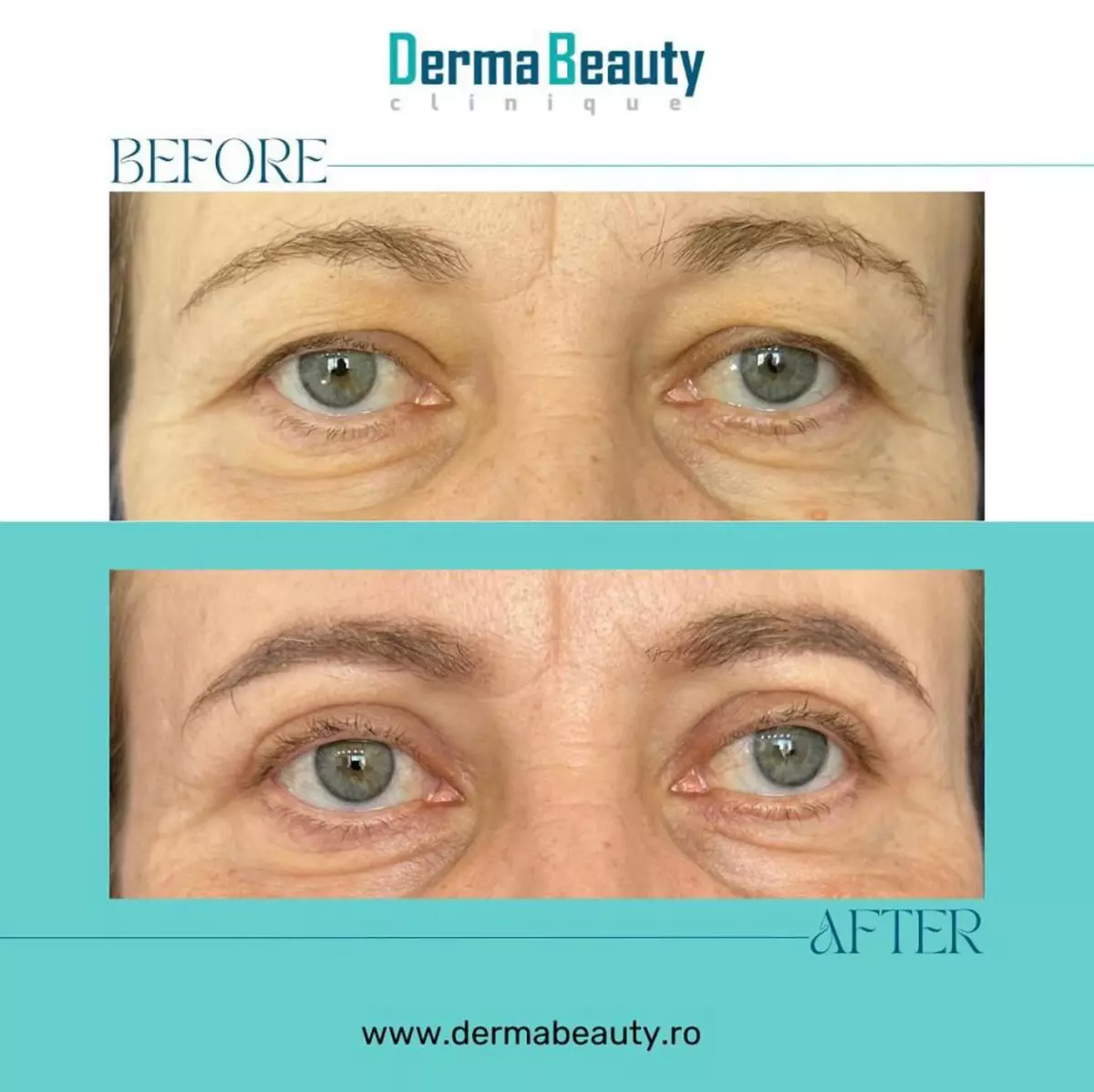 Pleoapele căzute, mai mult decât o problemă estetică. Află de la „Cel mai influent medic dermatolog din România care este rezolvarea