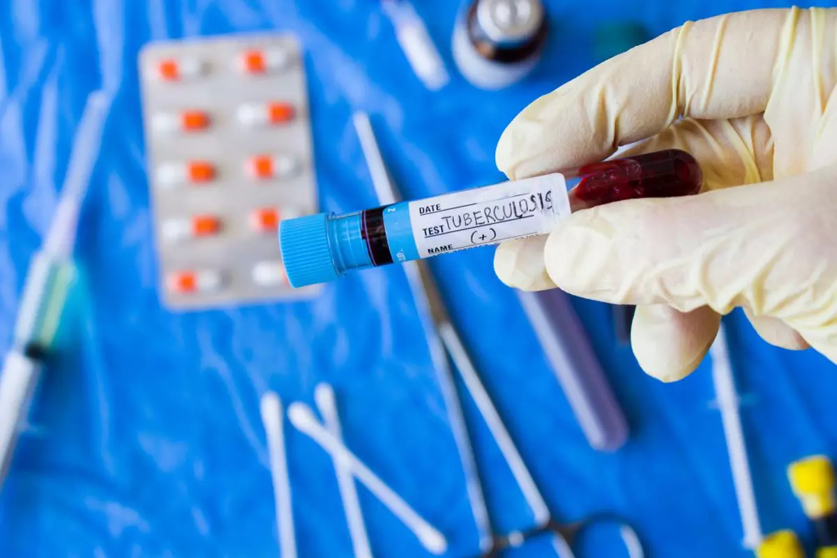 Tuberculoza a revenit pe prima poziție în clasamentul bolilor infecțioase mortale Sursă: Profimedia