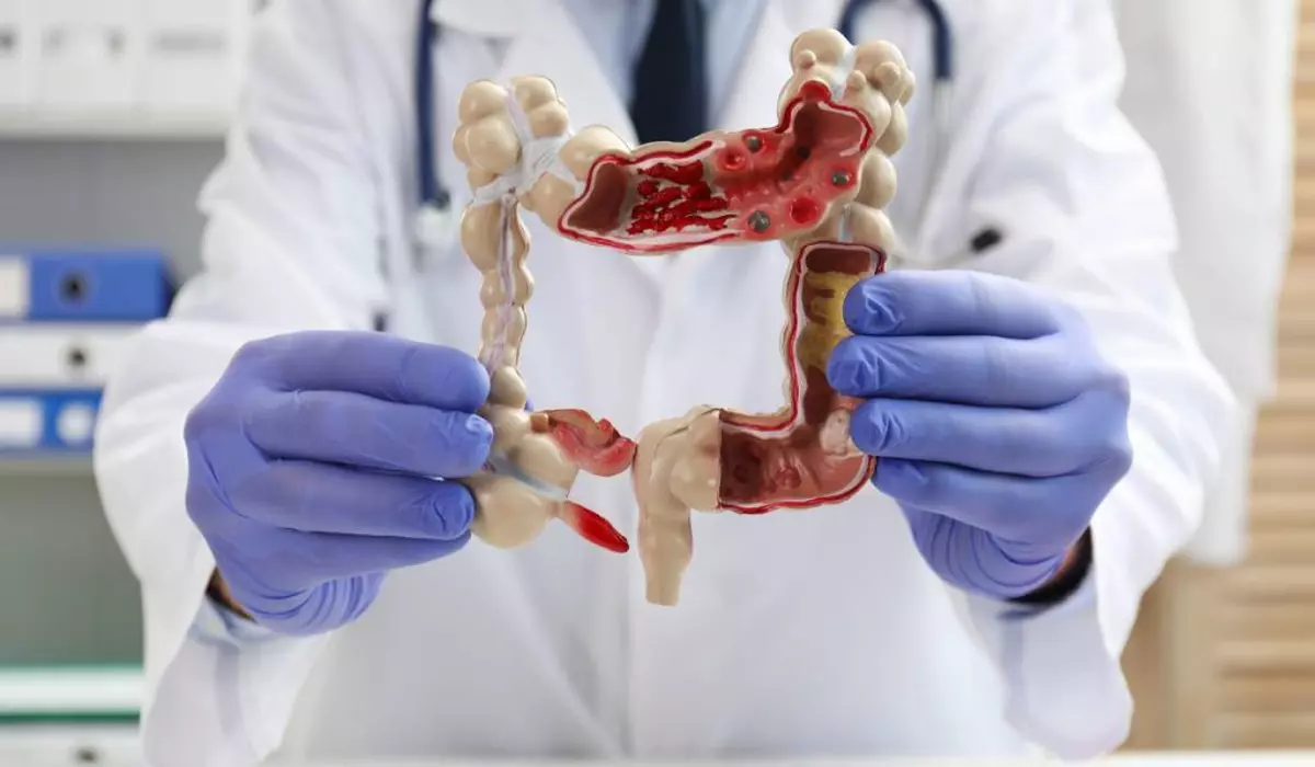 Medic îmbrăcat într-un halat alb, cu un stetoscop la gât și mănuși mov în mâini, ține o machetă de plastic care reprezintă colonul.