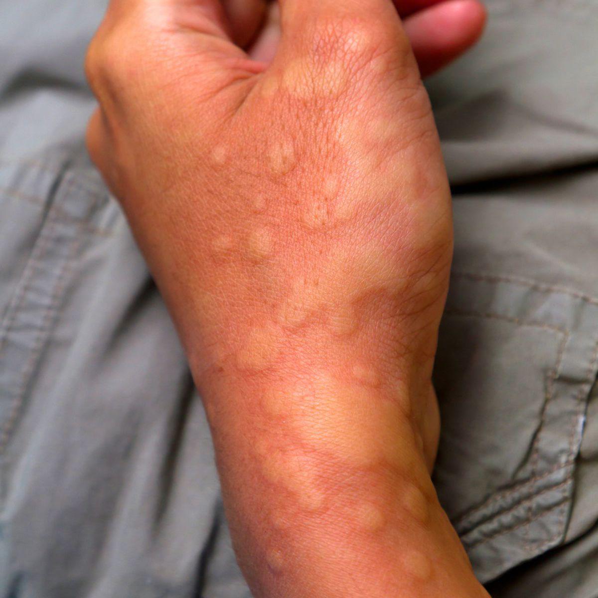 Alergiile Cutanate Si Urticaria Stiri Libertatea Libertatea