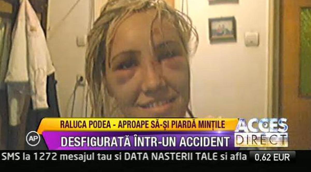 Raluca Podea a fost desfigurată într-un accident rutier | FOTO