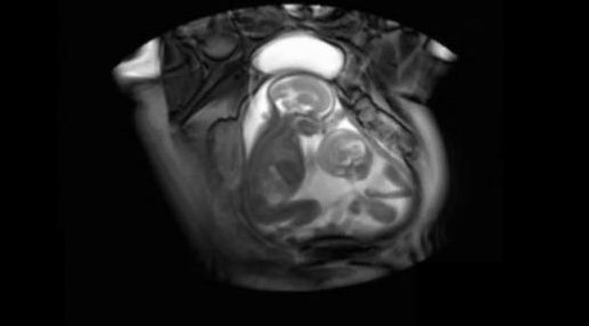 IMAGINI de NEÎNCHIPUIT! Uite prima bătaie între fraţi! Vezi cum se bat gemenii în burta mamei pentru mai mult spaţiu!