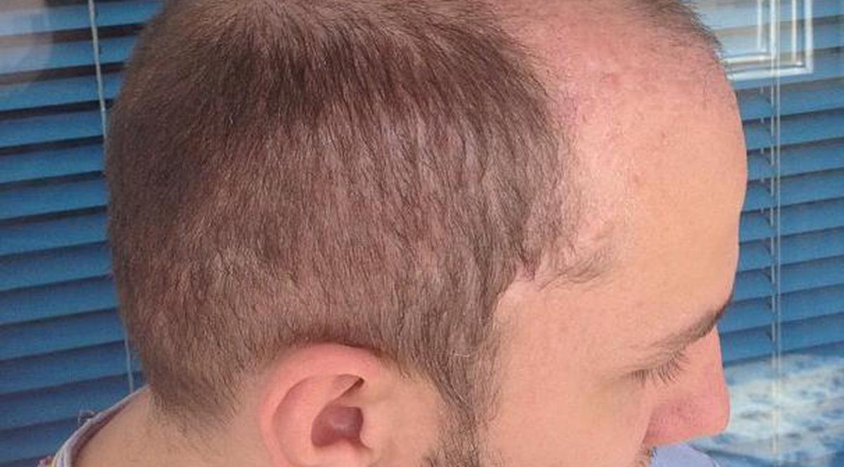 Drama lui Trăistariu, după operaţia de implant de păr: "A căzut APROAPE TOT" FOTO
