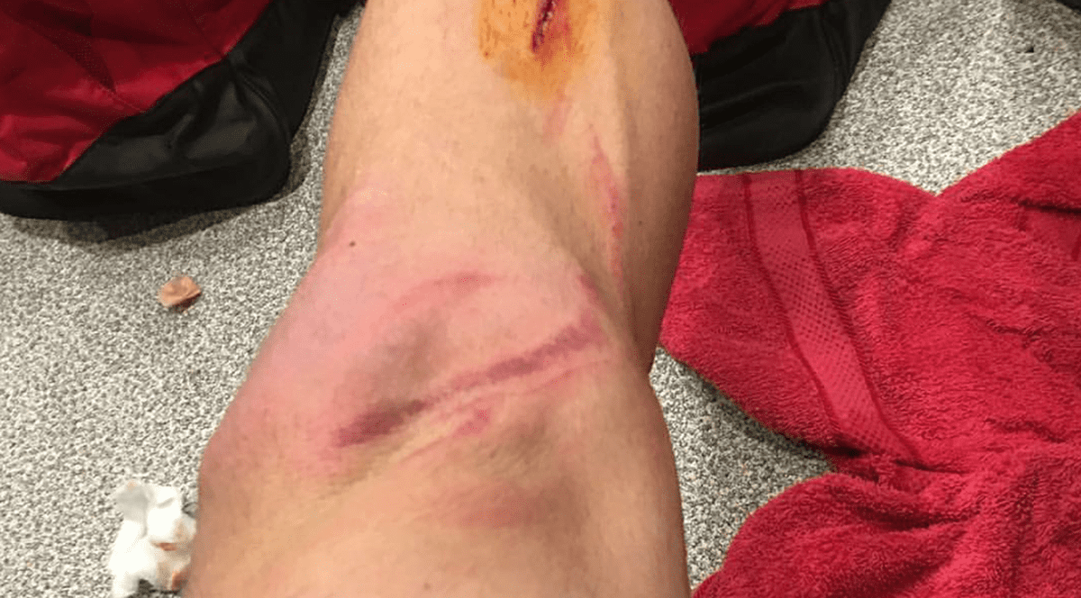 Liga 1. Așa arată piciorul unui dinamovist, după meciul cu Astra, de la Giurgiu. Cât va sta pe margine!