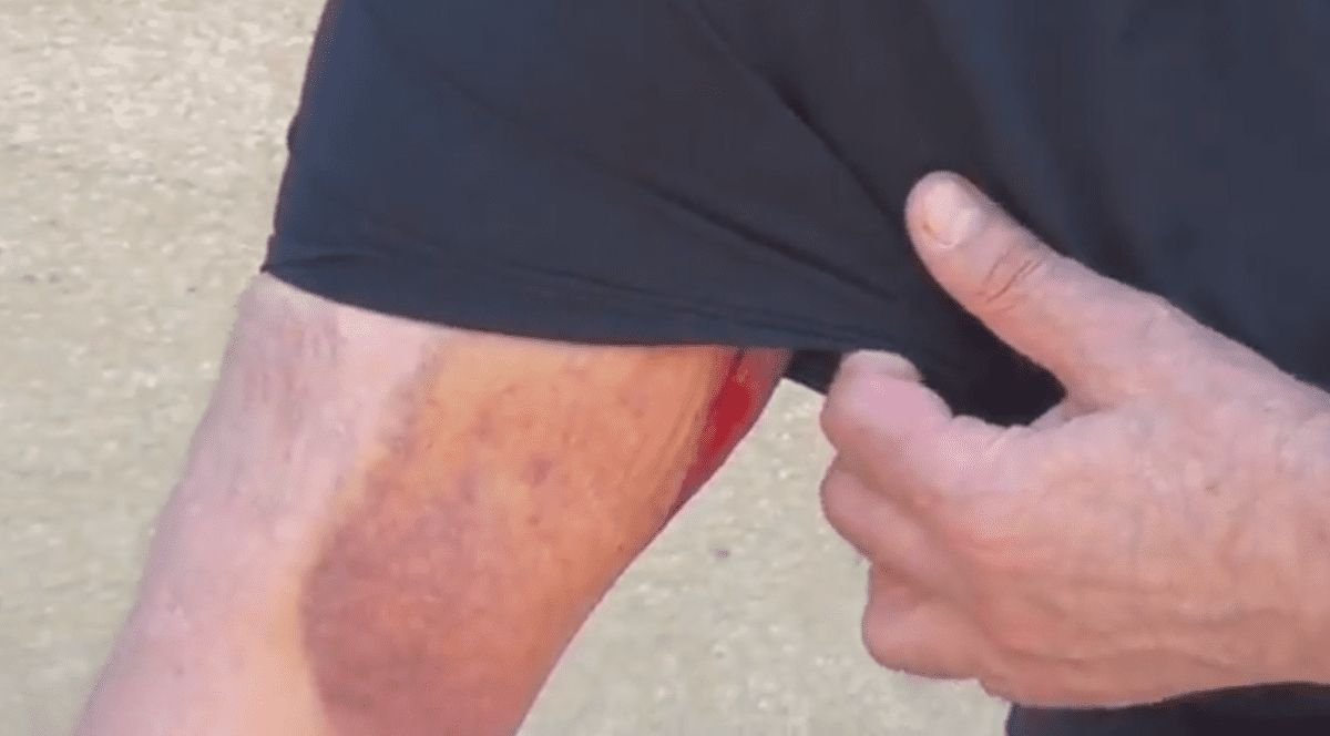 Mărturia unui medic bătut de jandarmi, pe 10 august. Brațul drept al medicului pensionar, plin de răni, după ce a fost bătut de jandarmi