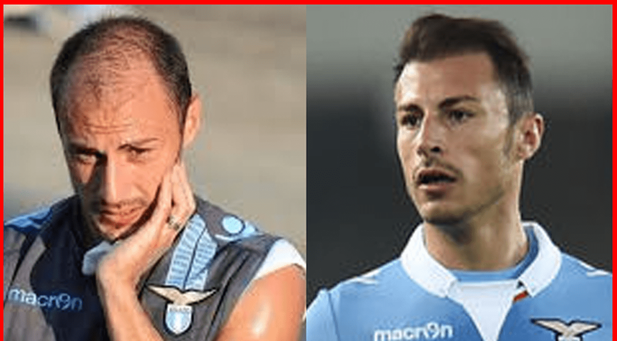 Fotbaliștii care și-au făcut implant de păr. Ștefan Radu și Walter Zenga, în top