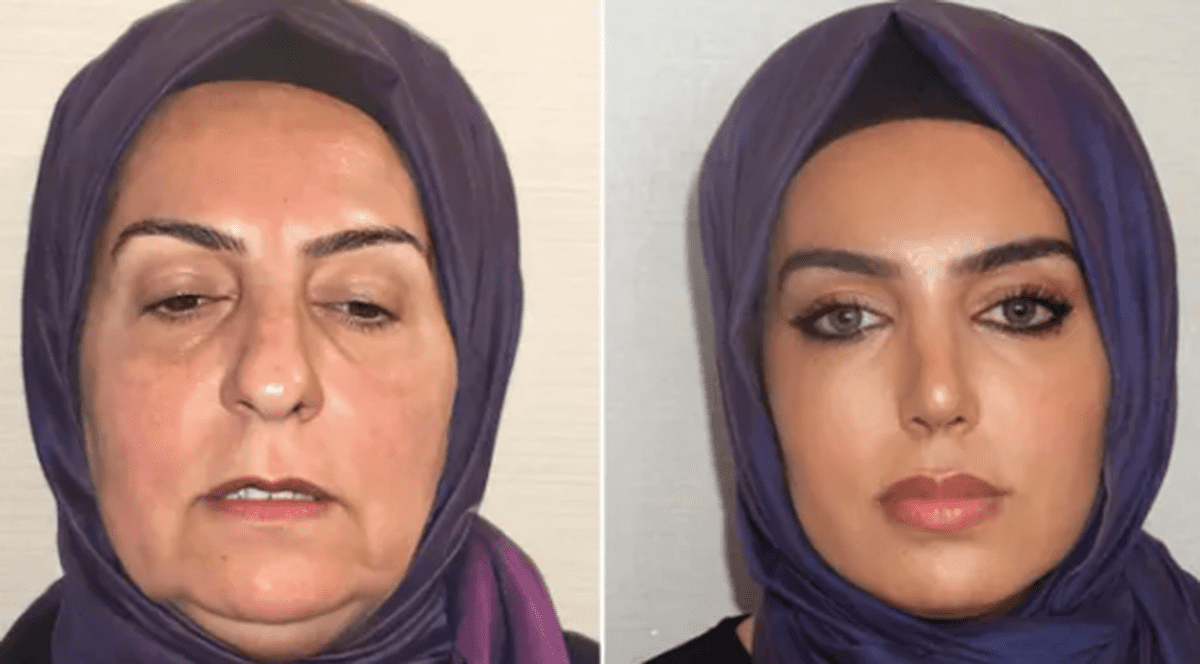 Fotografiile „înainte și după” distribuite de o clinică de chirurgie plastică din Turcia au împărțit internetul: „Dacă e real, vrem lista de prețuri”
