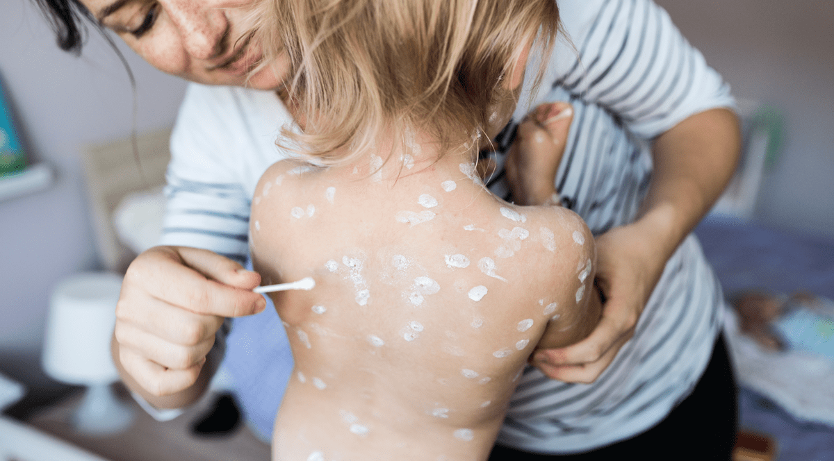 O fetita dezbracata sta cu spatele si mama ii pune pe bubite alifie. Val de cazuri de varicelă