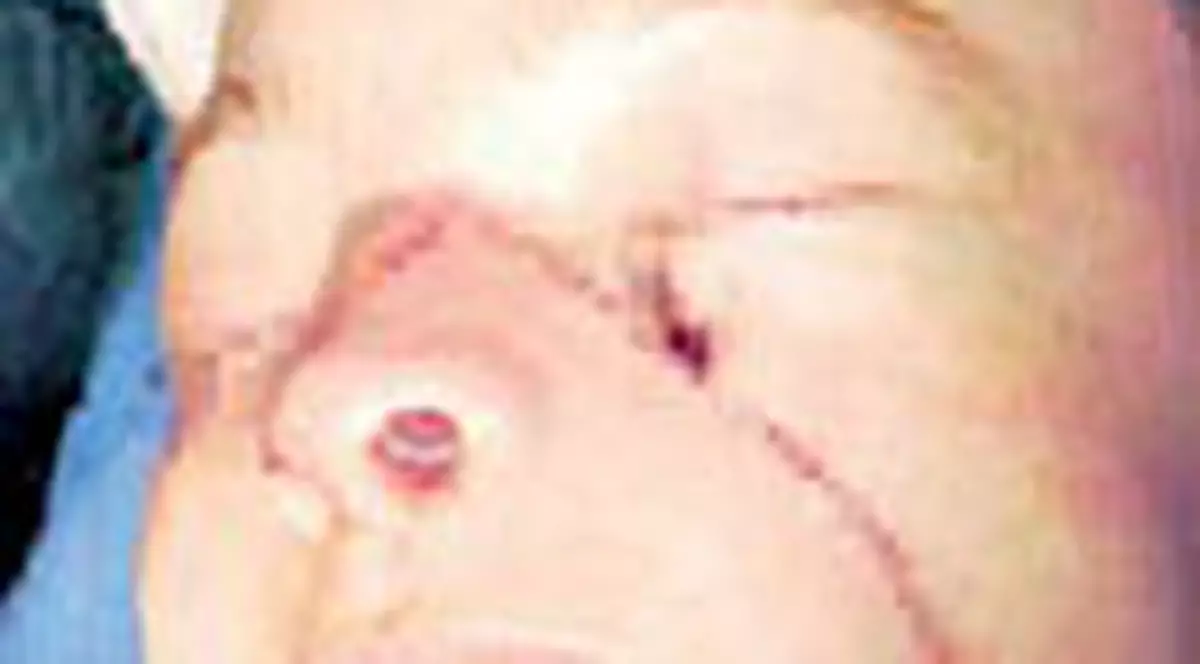 Femeia cu transplant de fata arata normal