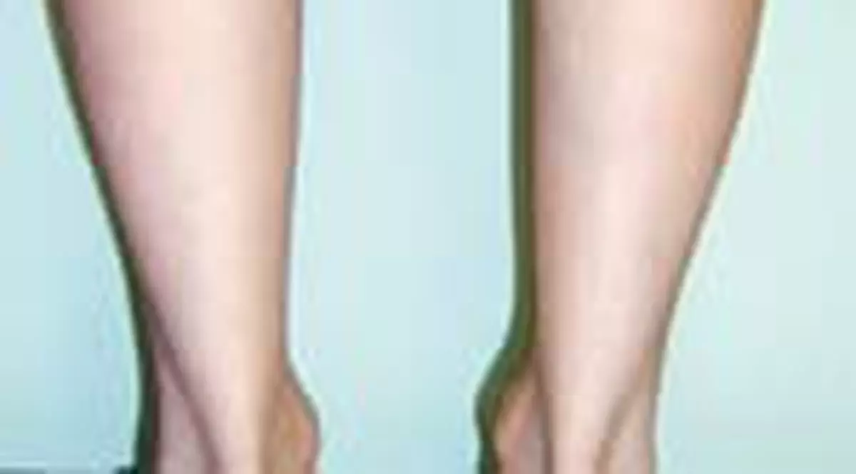 Picioare perfecte cu ajutorul silicoanelor