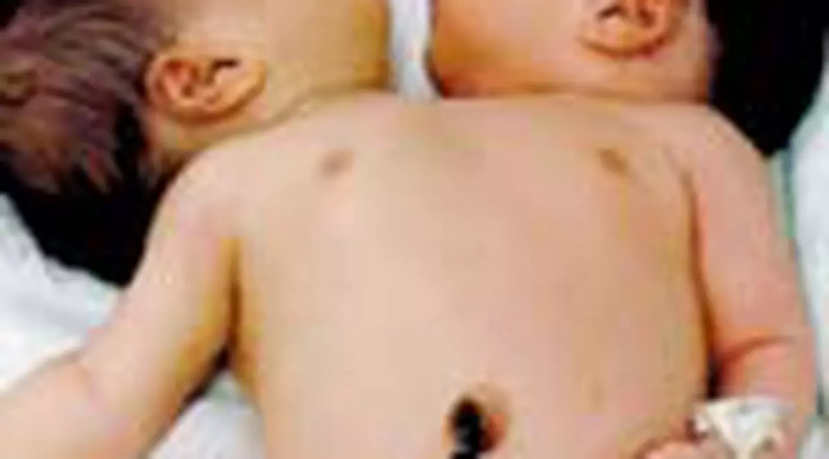 Fetita cu doua capete, pe moarte