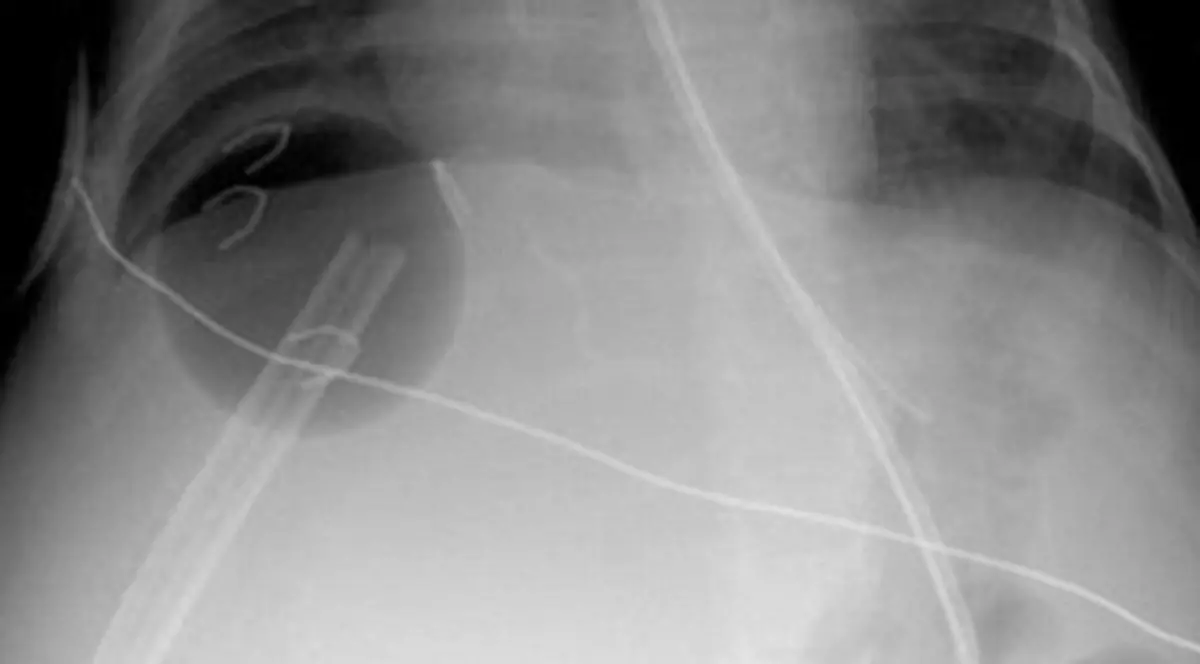 I-au implantat o minge de ping-pong sub ficat