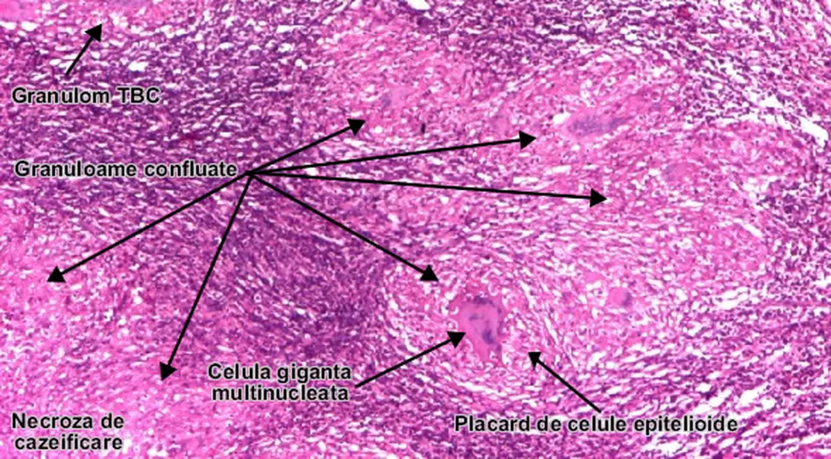 S-a găsit un tratament pentru Tuberculoză