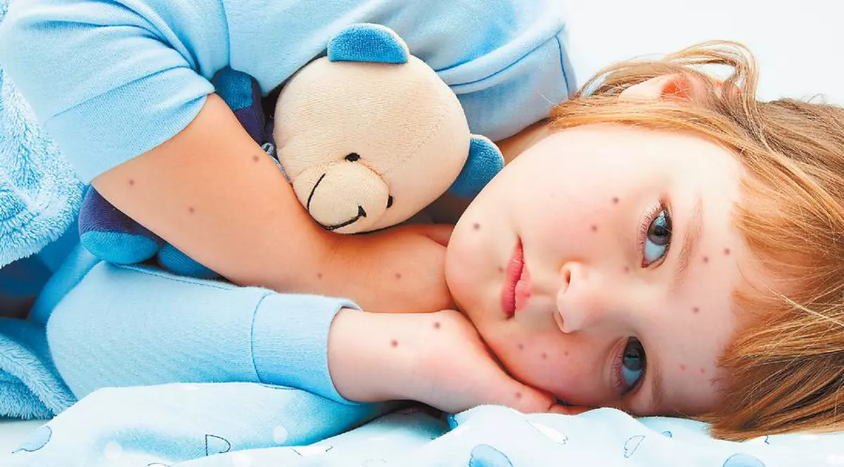 A făcut varicelă? Dă-i să bea multe lichide!