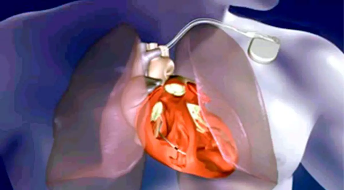 I se opreşte inima atunci când mănâncă