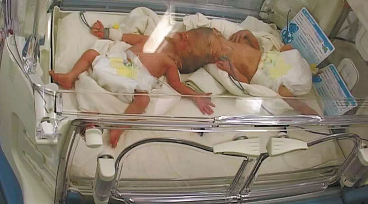 El vrea să-i separe pe siamezi