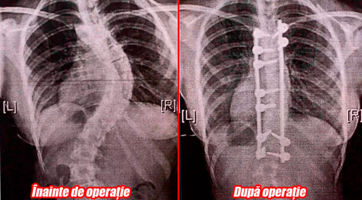 A crescut cu 5 centimetri după ce i-au îndreptat coloana