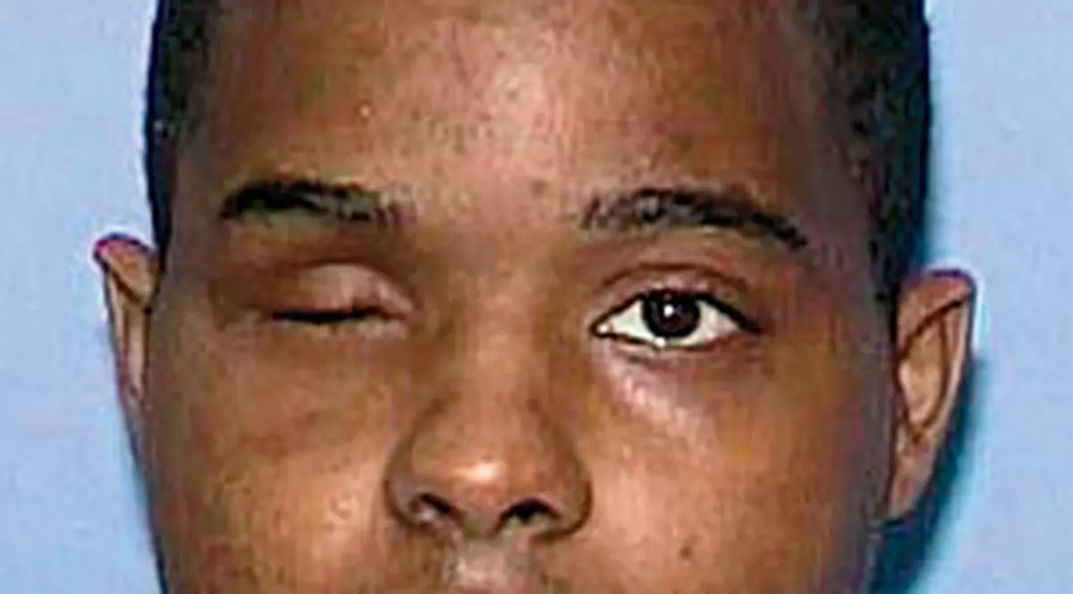 Şi-a mâncat propriii ochi după ce şi i-a scos