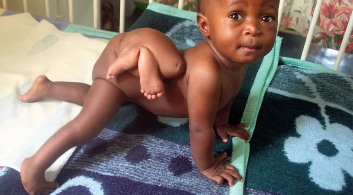 S-a născut o fetiţă cu patru picioare!!!