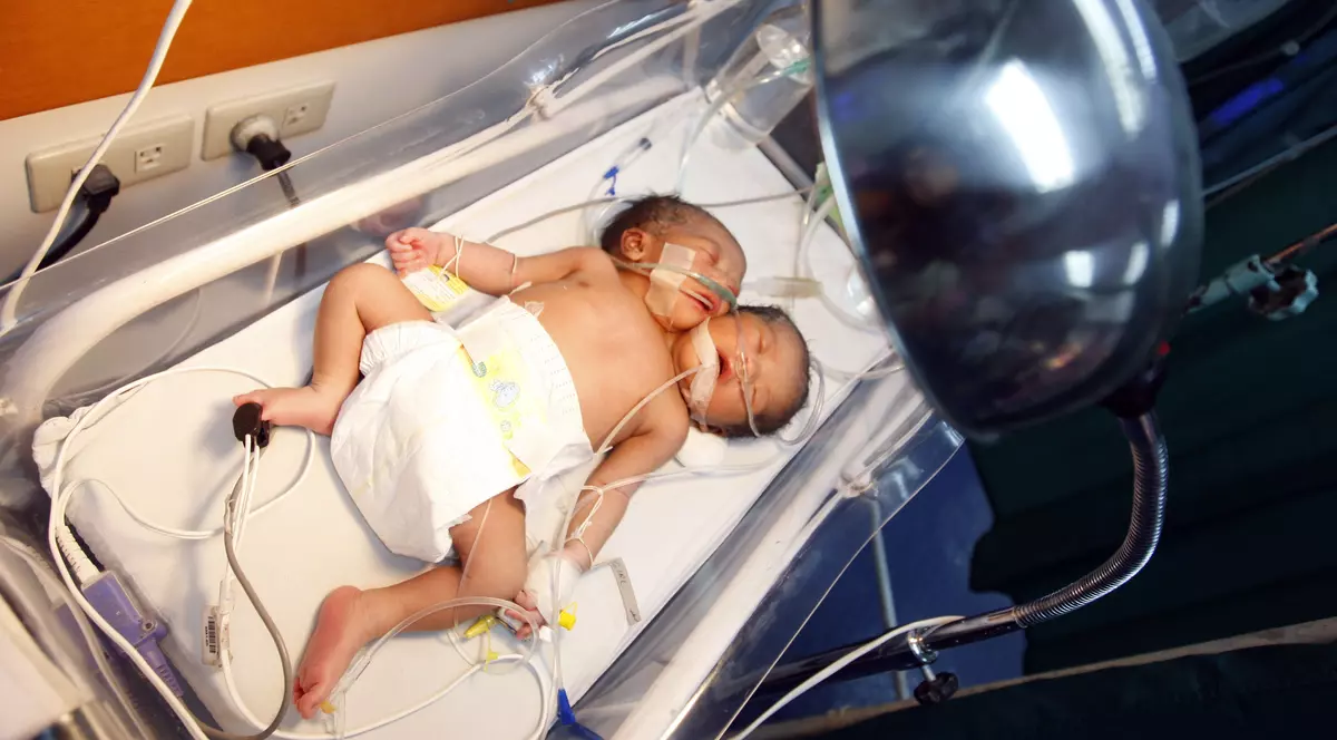 Bebeluş cu două capete, în Filipine