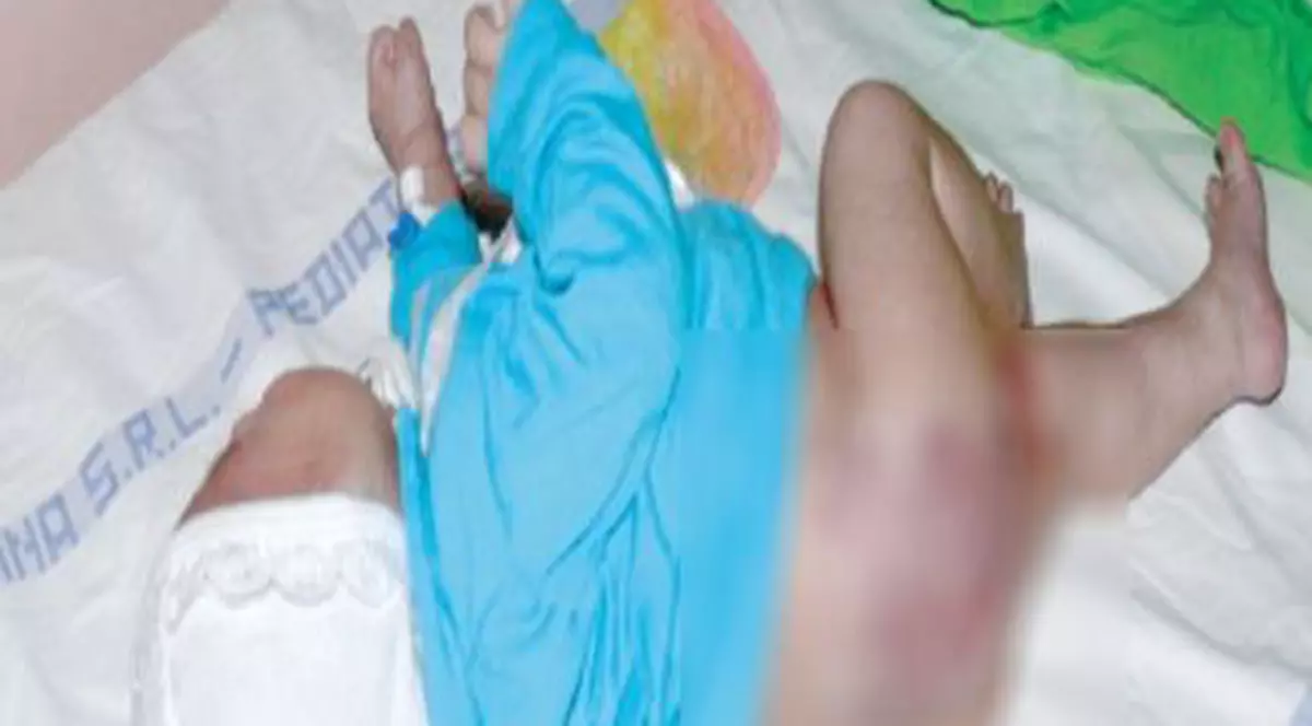 Un nou-născut riscă să-şi piardă un picior