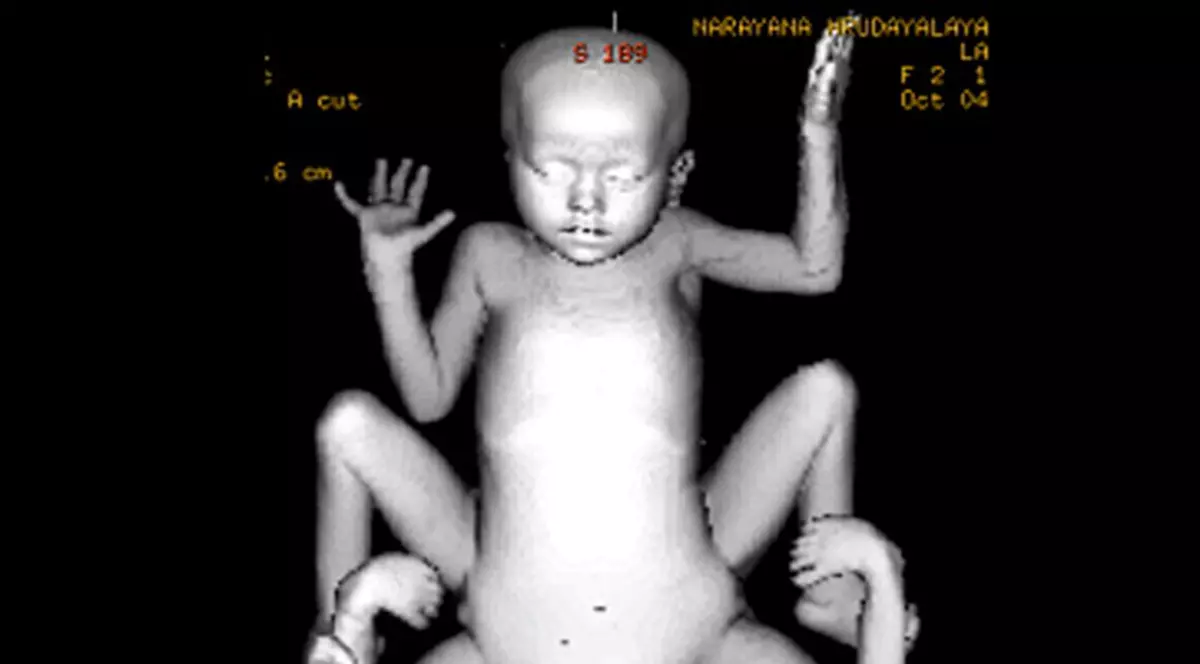 Copil cu opt membre, născut în Nepal
