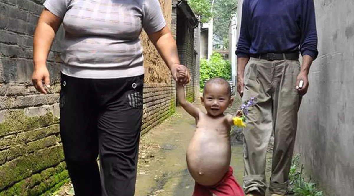 Foto / Fetiţa însărcinată cu fratele ei geamăn a fost operată