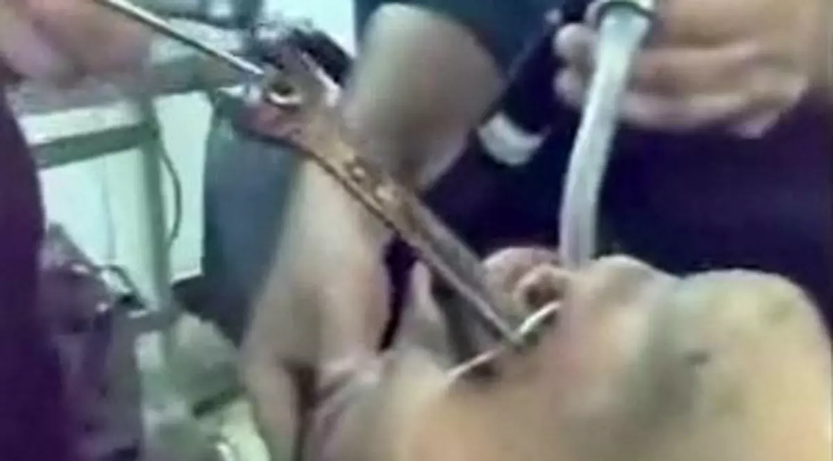 Video / I-au scos o cheie inelară din stomac