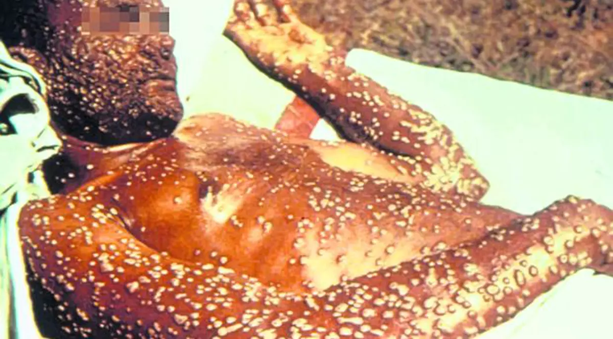 8 mai 1980, ziua când virusul variolei a fost declarat eradicat. Cum a reușit omenirea să combată o altă epidemie devastatoare