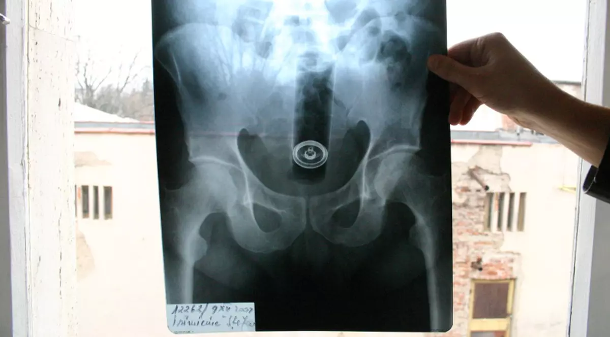 A stat trei zile cu tubul unui spray în anus