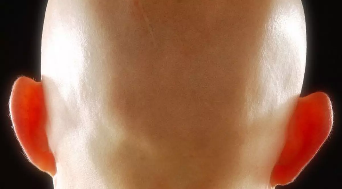 S-a descoperit gena responsabilă pentru chelire