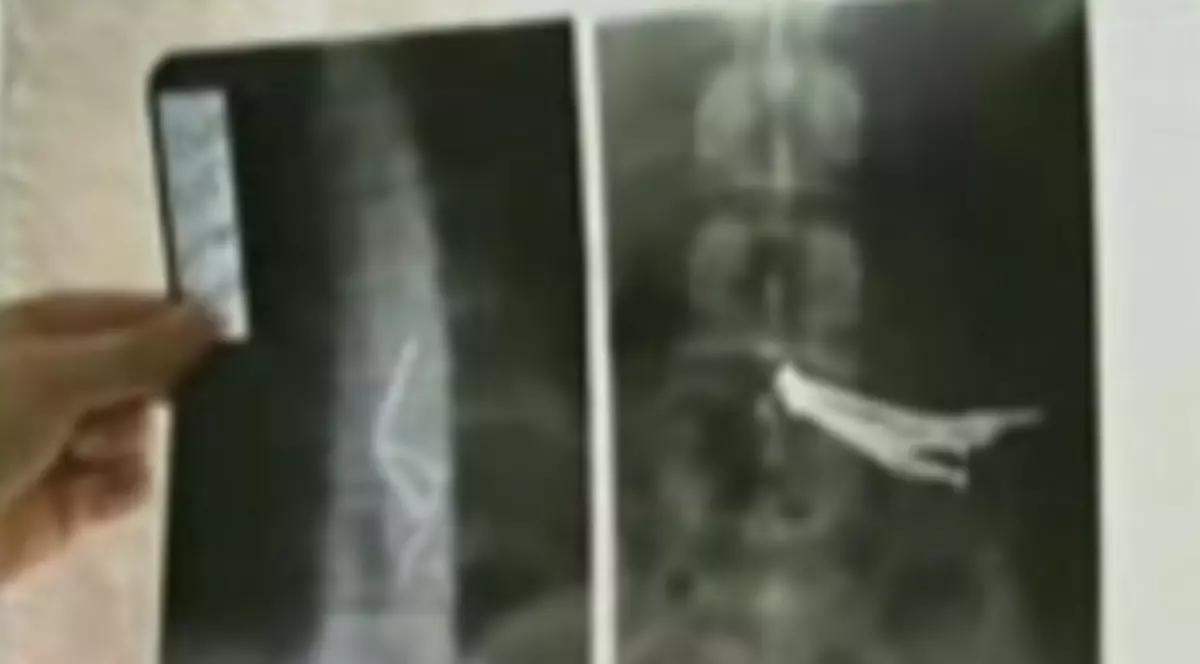 Supărat că a fost părăsit de iubită, a înghiţit un pumn de cuie