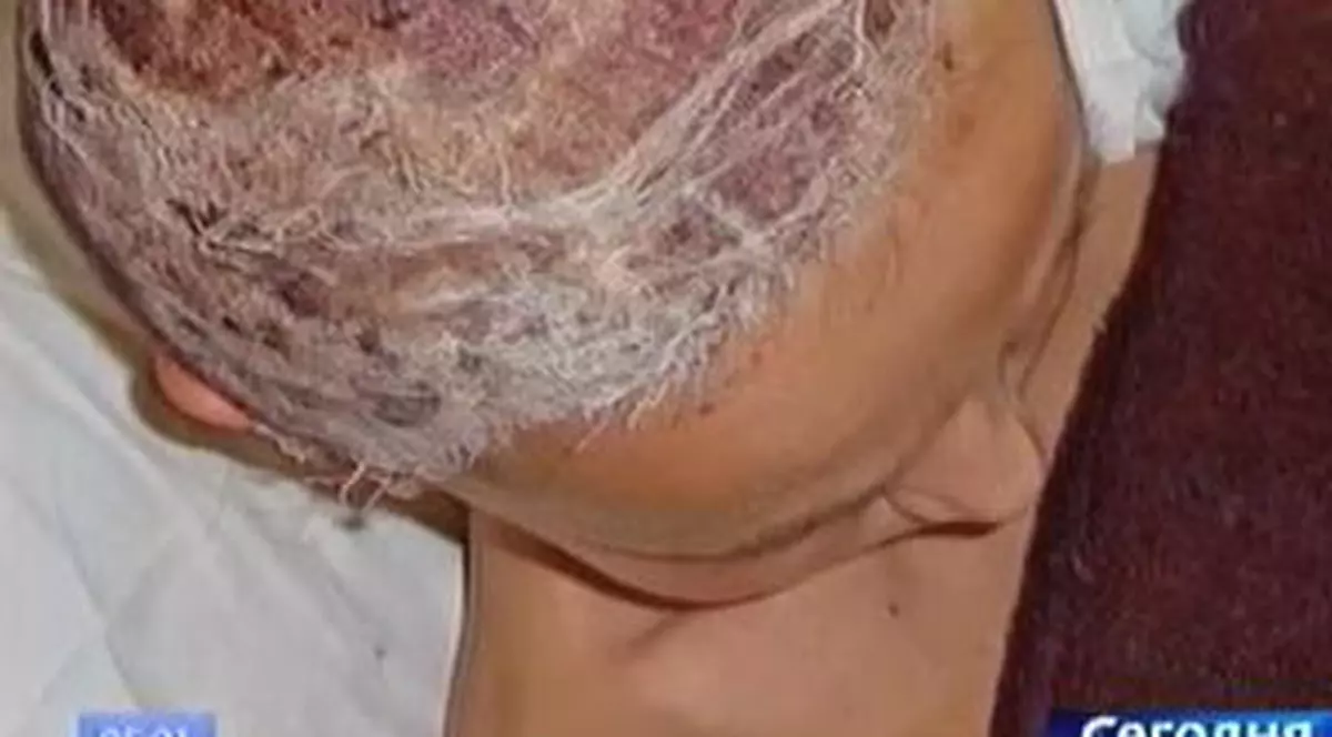 O fetiţă de zece ani a luat foc pe masa de operaţii