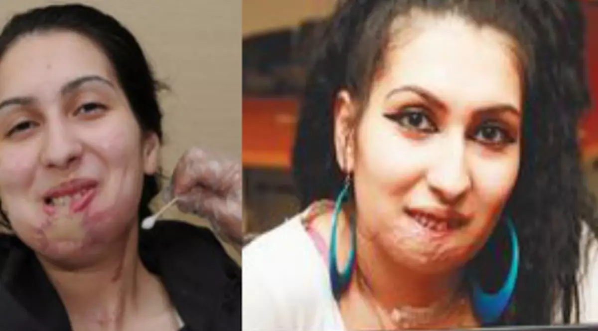 Fața unei bucureștence desfigurată într-un accident, reconstruită în Taiwan