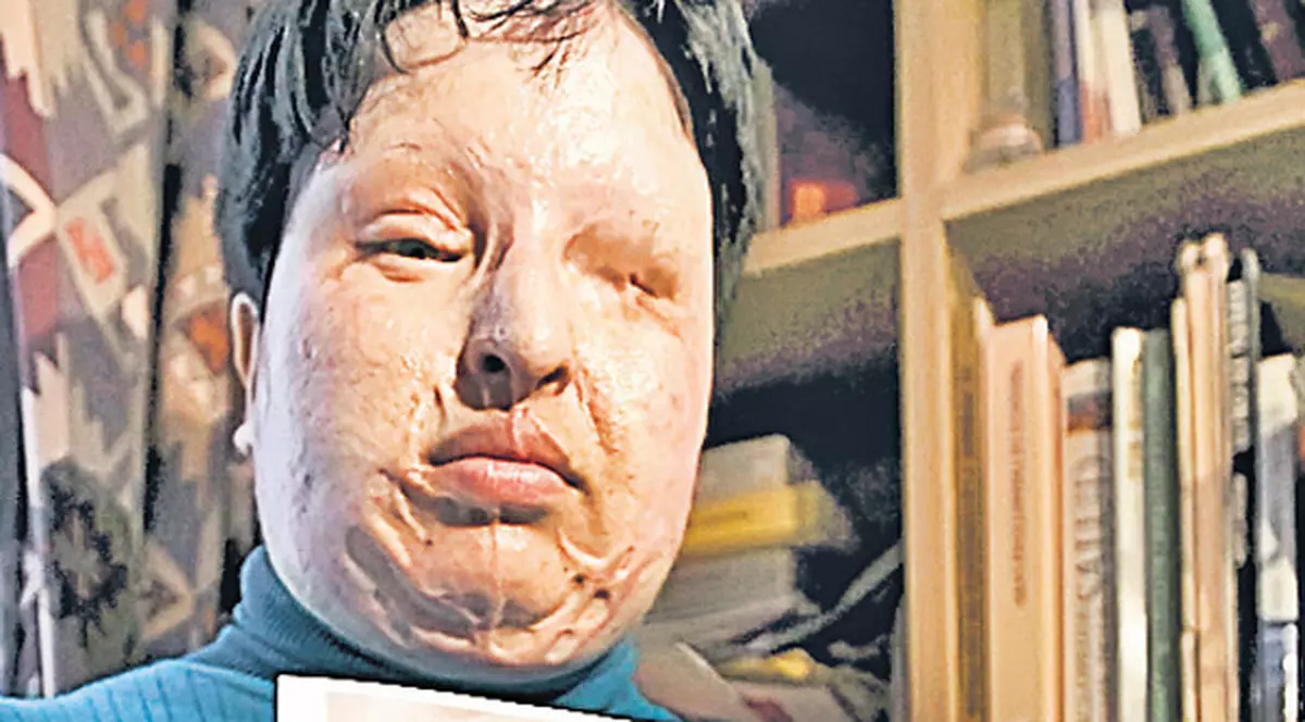 Iraniana desfigurată de iubit cu acid sulfuric: "Vreau să-l aud urlând de durere"