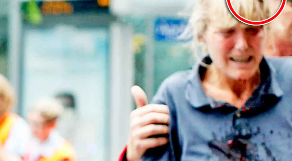 I-a intrat în cap o ţepuşă de 30 cm!