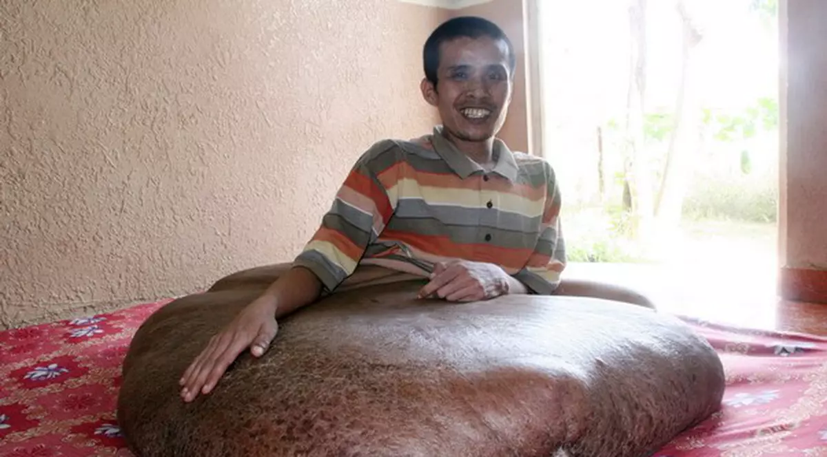 Nguyen Duy Hai a scăpat de tumoarea de 80 de kilograme! | FOTO