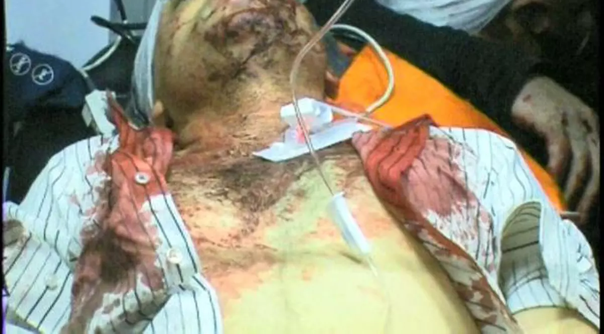 Viceprimar bătut cu bâtele pe stradă