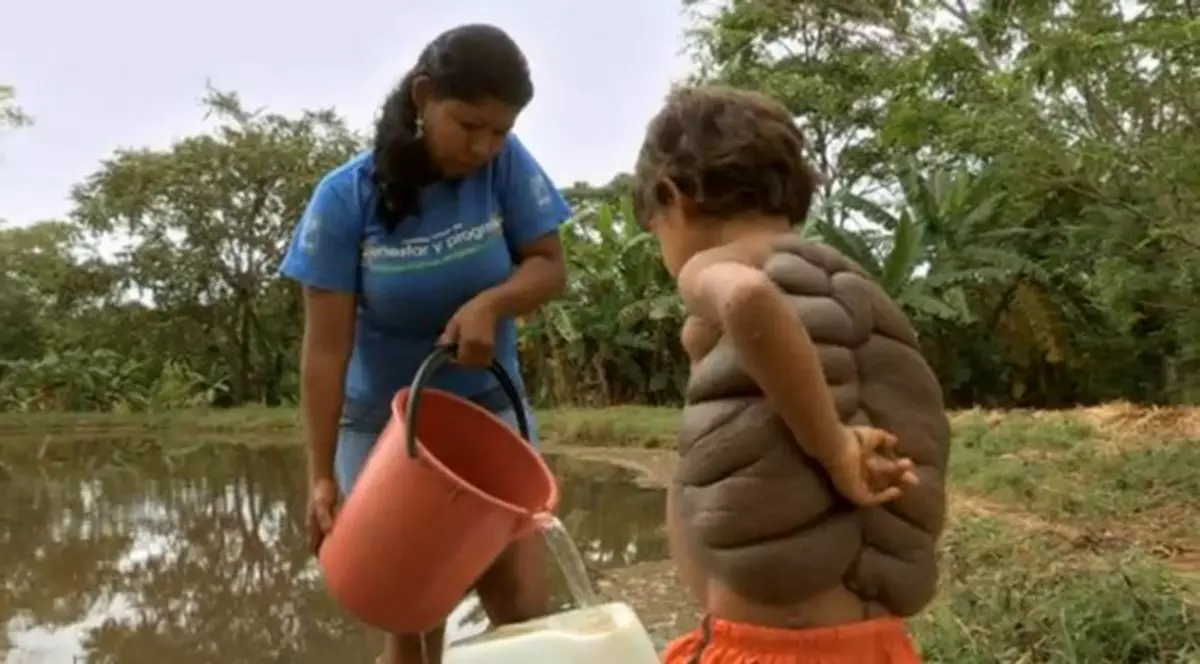 Drama copilului care a impresionat planeta a luat sfârşit! Cum arată "băiatul-ţestoasă" fără carapace! FOTO