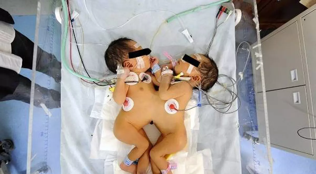 A murit şi cea de-a două siameză! Ieri, sora sa a plecat dintre noi!