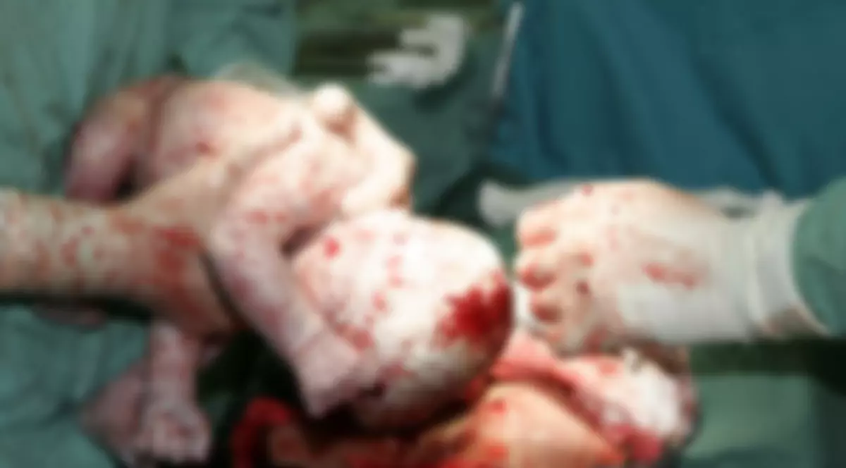 Clipe de GROAZĂ! Bebeluş, DECAPITAT la naştere