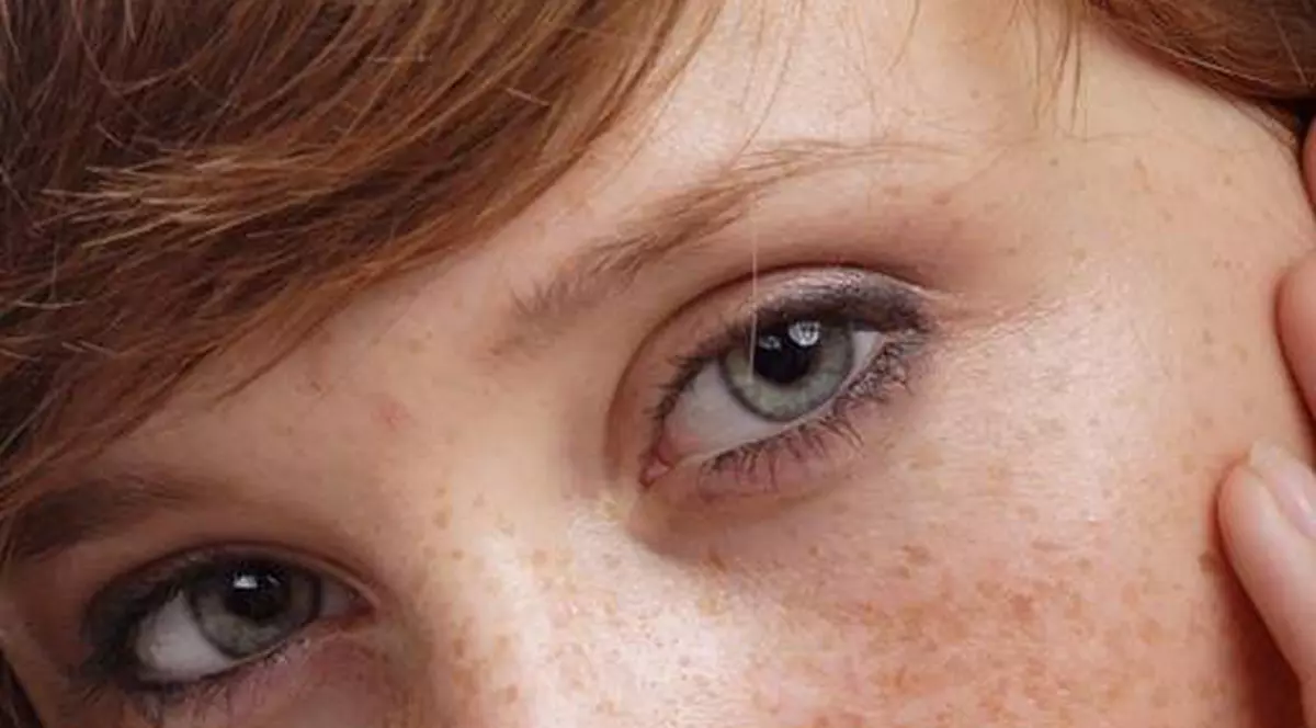 Sucul de castravete înlătură pistruii