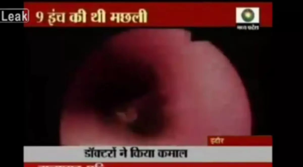 Imaginile incredibile din momentul în care unui băiat i s-a scos un PEŞTE VIU din PLĂMÂNI | VIDEO ŞOCANT