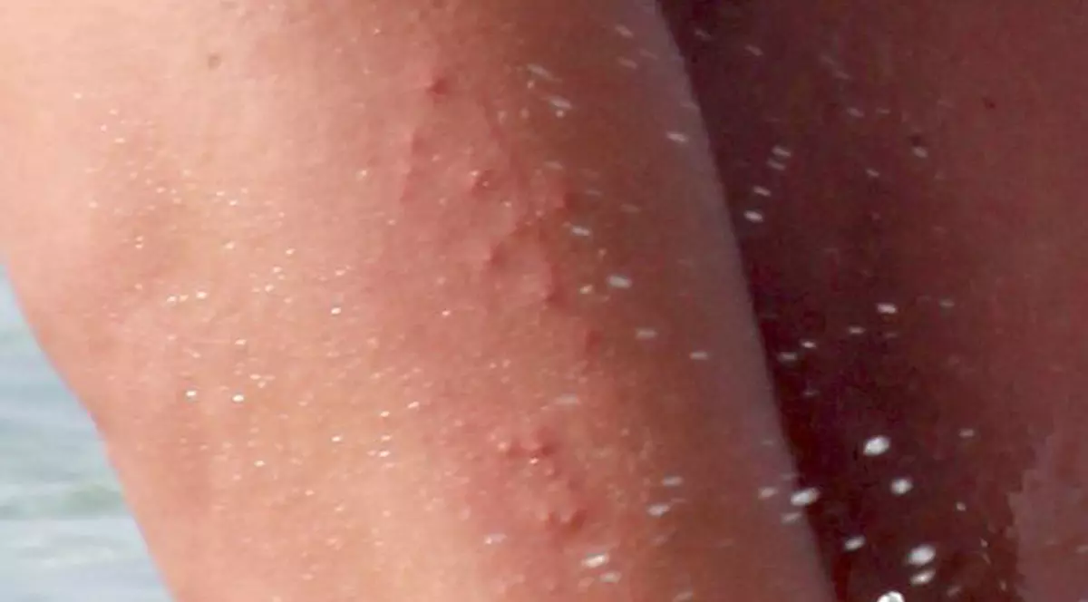 Fosta IUBITĂ A LUI BOTE, plină de BUBE pe PICIOARE, la PLAJĂ | Foto